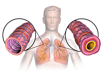 Методы лечения бронхиальной астмы