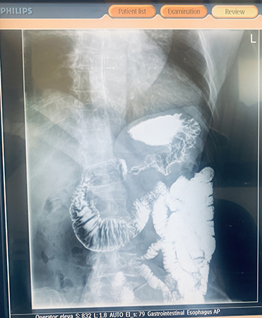 рентген желудка с барием