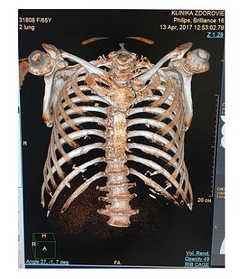 3D КТ грудного отдела позвоночника