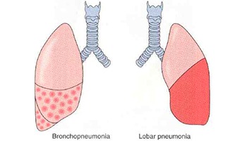 Долевая пневмония