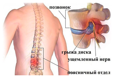 МРТ поясничного отдела позвоночника