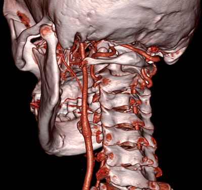 КТ головного мозга и шейного отдела позвоночника с 3D