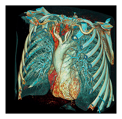 Комплексная томография с контрастом (органы грудной клетки и брюшной полости)
