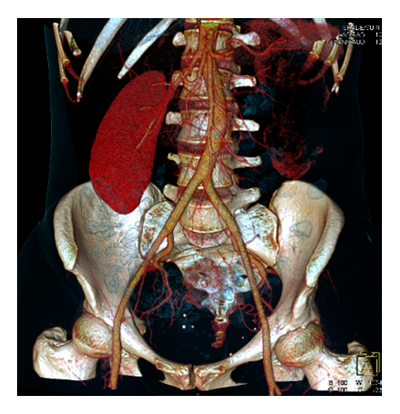 Комплексная томография (органы грудной клетки и малого таза)