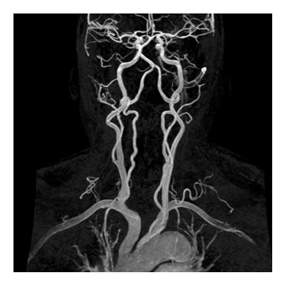 КТ ангиография брахиоцефальных артерий