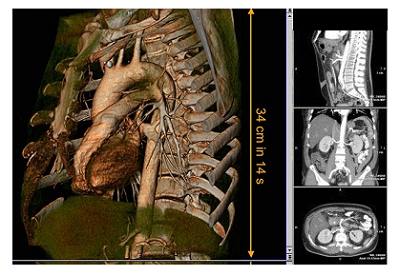 Компьютерная томография органов грудной клетки: методика проведения и диагностическое значение