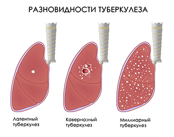 Методы лечения туберкулеза
