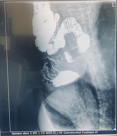 рентген желудка с барием